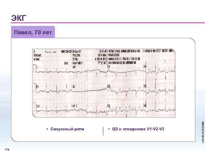 ЭКГ • Синусовый ритм 119 • QS в отведениях V 1 -V 2 -V