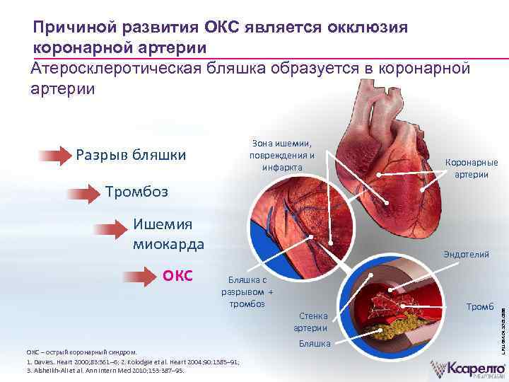 Коронарный атеросклероз в картинках