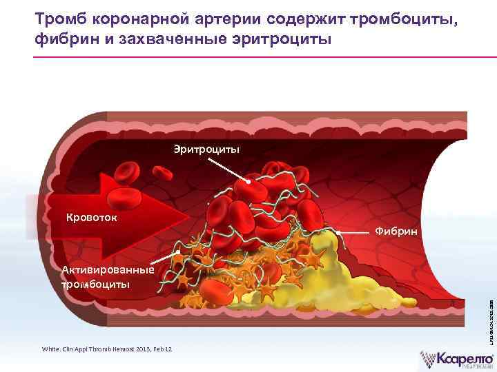 Тромбоз коронарных артерий. Тромбоцитарный фибрин тромбоциты. Тромбоциты образование тромба. Тромбоцитарный и фибриновый тромб. Образование тромба в коронарной артерии.