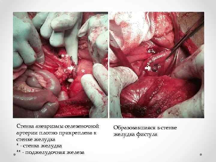 Стенка аневризмы селезеночной артерии плотно прикреплена к стенке желудка * - стенка желудка **
