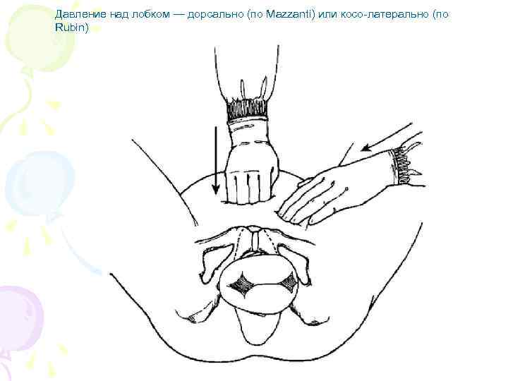 Давление над лобком — дорсально (по Mazzanti) или косо-латерально (по Rubin) 