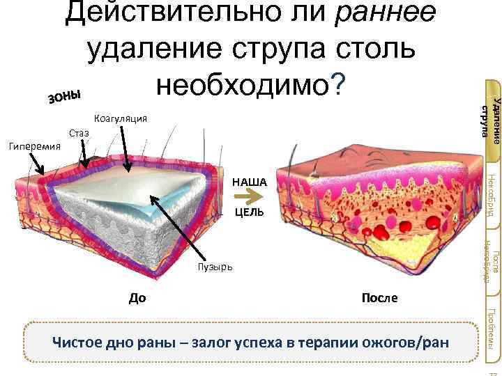 Коагуляция Гиперемия Стаз Нексо. Брид НАША ЦЕЛЬ После Нексо. Брида Пузырь До Удаление струпа