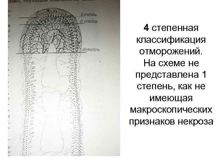 4 степенная классификация отморожений. На схеме не представлена 1 степень, как не имеющая макроскопических