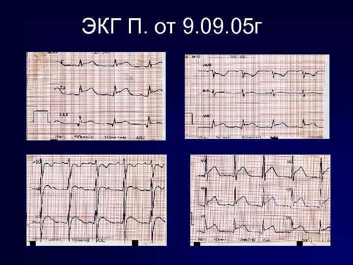 ЭКГ П. от 9. 05 г 