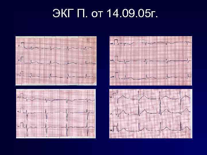 ЭКГ П. от 14. 09. 05 г. 