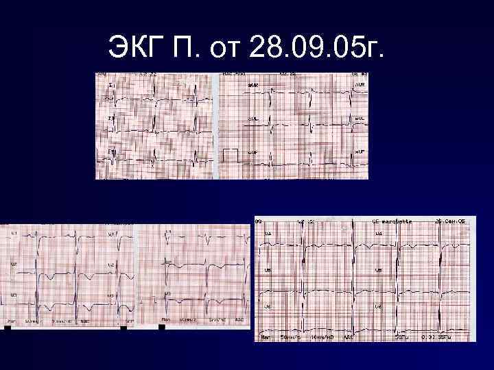 ЭКГ П. от 28. 09. 05 г. 