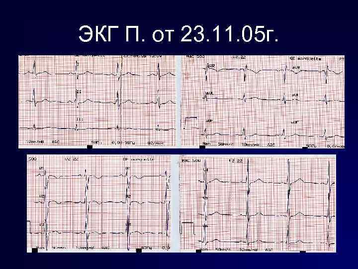 ЭКГ П. от 23. 11. 05 г. 