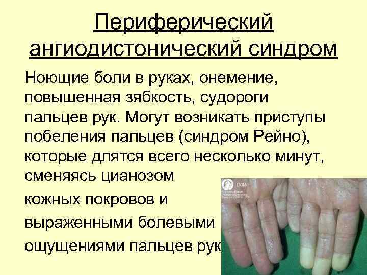 Периферический ангиодистонический синдром Ноющие боли в руках, онемение, повышенная зябкость, судороги пальцев рук. Могут