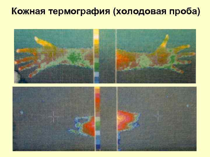 Кожная термография (холодовая проба) 