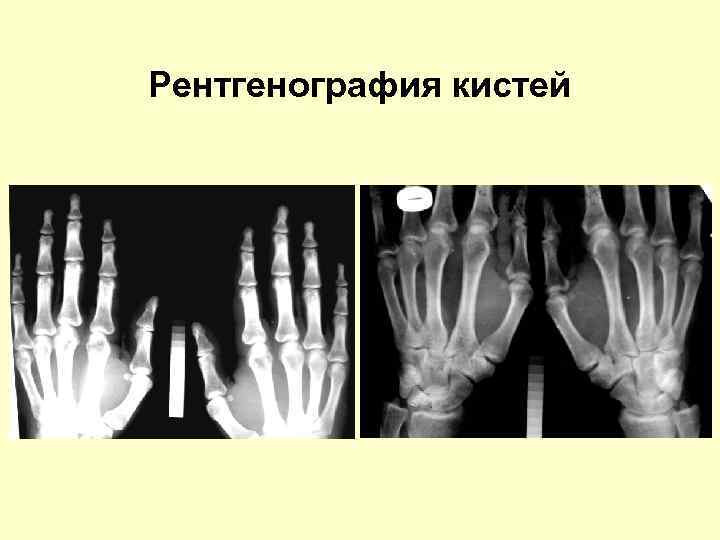 Рентгенография кистей 