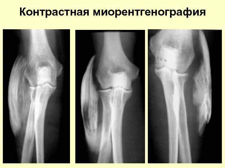 Контрастная миорентгенография 