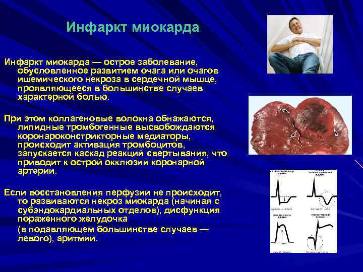 Инфаркт миокарда — острое заболевание, обусловленное развитием очага или очагов ишемического некроза в сердечной