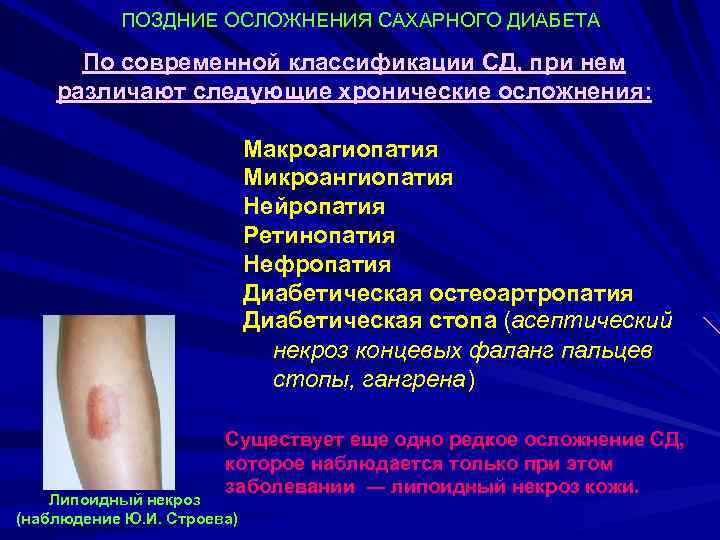 ПОЗДНИЕ ОСЛОЖНЕНИЯ САХАРНОГО ДИАБЕТА По современной классификации СД, при нем различают следующие хронические осложнения: