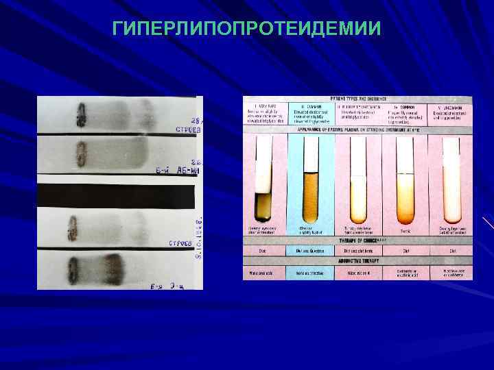 ГИПЕРЛИПОПРОТЕИДЕМИИ 