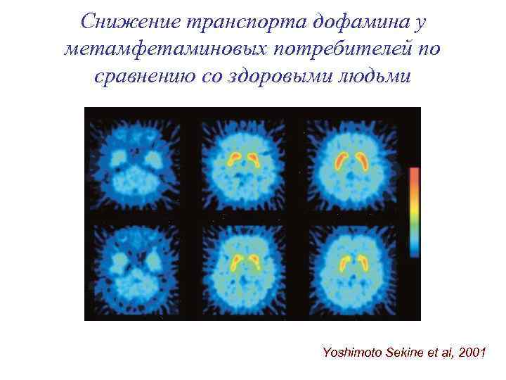 Снижение транспорта дофамина у метамфетаминовых потребителей по сравнению со здоровыми людьми Yoshimoto Sekine et
