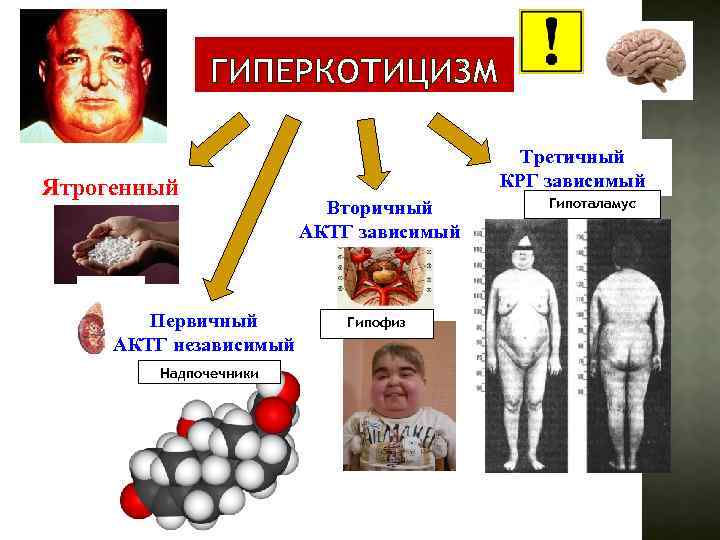 ГИПЕРКОТИЦИЗМ Ятрогенный Первичный АКТГ независимый Надпочечники Третичный КРГ зависимый Вторичный АКТГ зависимый Гипофиз Гипоталамус