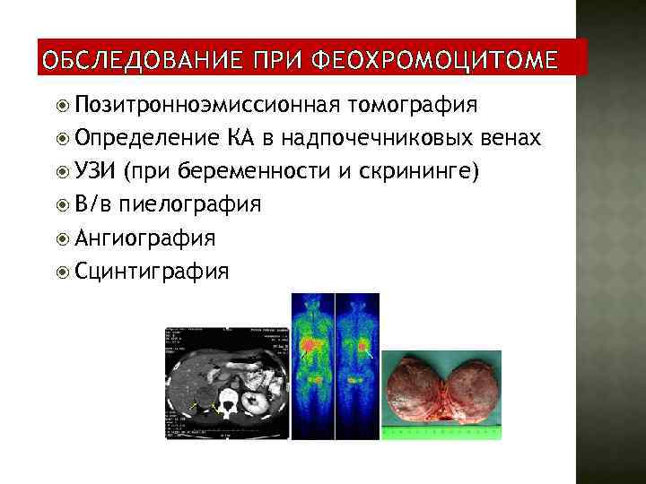 Феохромоцитома план обследования