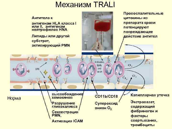 Механизм TRALI Провоспалительные цитокины из препарата крови потенцируют повреждающее действие антител Антитела к антигенам