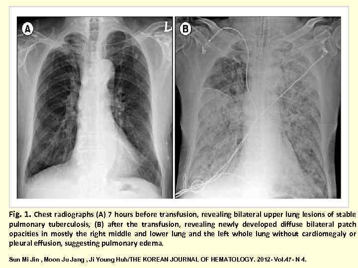 Fig. 1. Chest radiographs (A) 7 hours before transfusion, revealing bilateral upper lung lesions