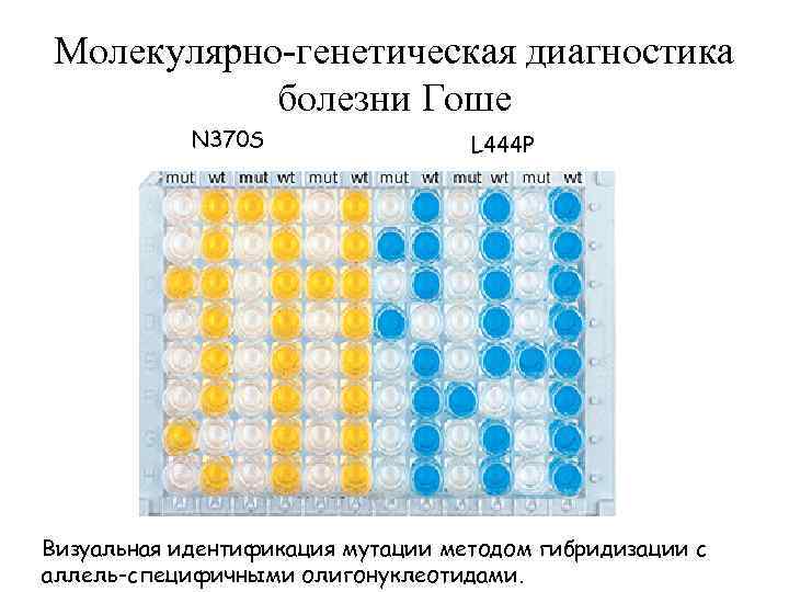 Молекулярно-генетическая диагностика болезни Гоше N 370 S L 444 P Визуальная идентификация мутации методом
