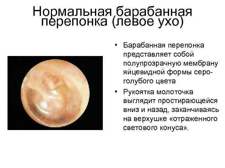 Нормальная барабанная перепонка (левое ухо) • Барабанная перепонка представляет собой полупрозрачную мембрану яйцевидной формы