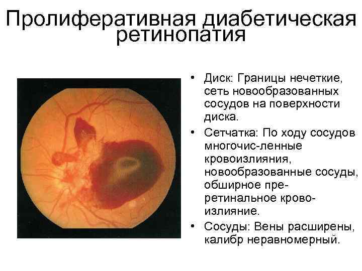 Пролиферативная диабетическая ретинопатия • Диск: Границы нечеткие, сеть новообразованных сосудов на поверхности диска. •