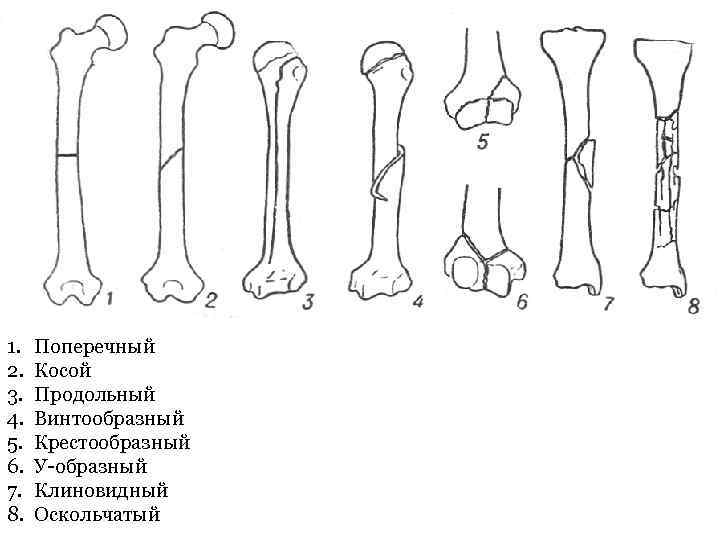 1. 2. 3. 4. 5. 6. 7. 8. Поперечный Косой Продольный Винтообразный Крестообразный У-образный