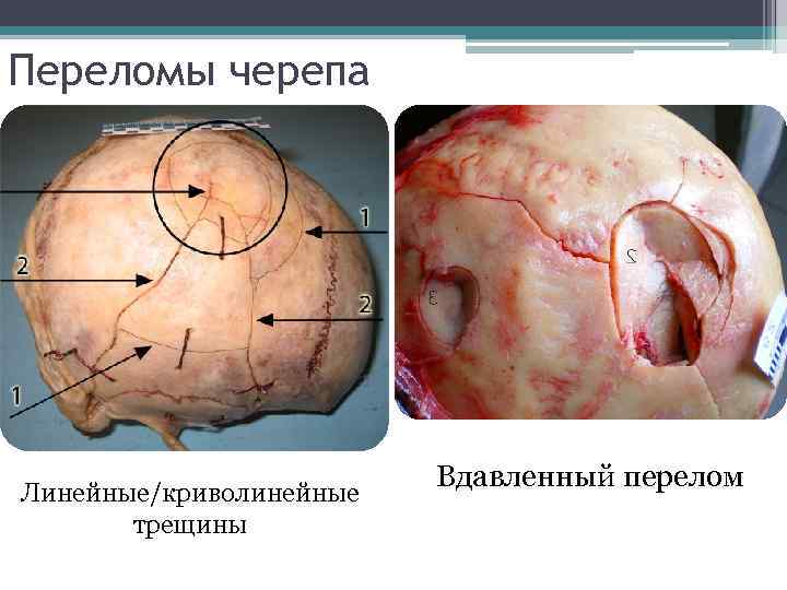 Переломы черепа Линейные/криволинейные трещины Вдавленный перелом 