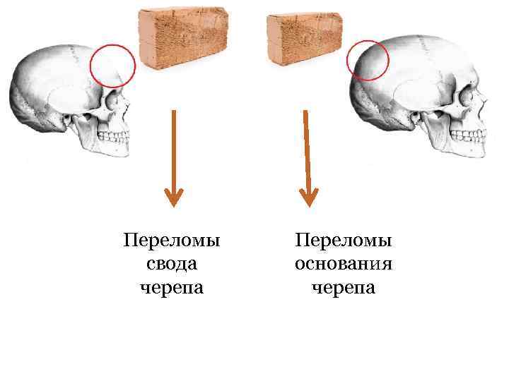 Переломы свода черепа Переломы основания черепа 