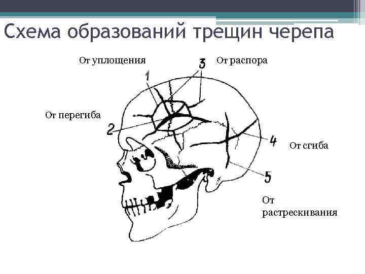 Схема образований трещин черепа От уплощения От распора От перегиба От сгиба От растрескивания