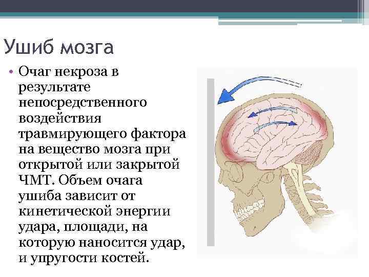 Ушиб мозга • Очаг некроза в результате непосредственного воздействия травмирующего фактора на вещество мозга