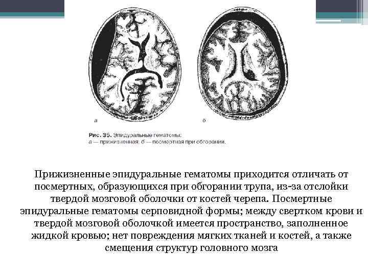 Прижизненные эпидуральные гематомы приходится отличать от посмертных, образующихся при обгорании трупа, из-за отслойки твердой