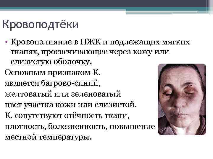 Кровоподтёки • Кровоизлияние в ПЖК и подлежащих мягких тканях, просвечивающее через кожу или слизистую