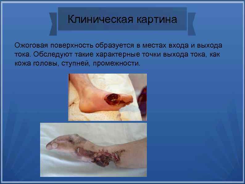 Клиническая картина Ожоговая поверхность образуется в местах входа и выхода тока. Обследуют такие характерные