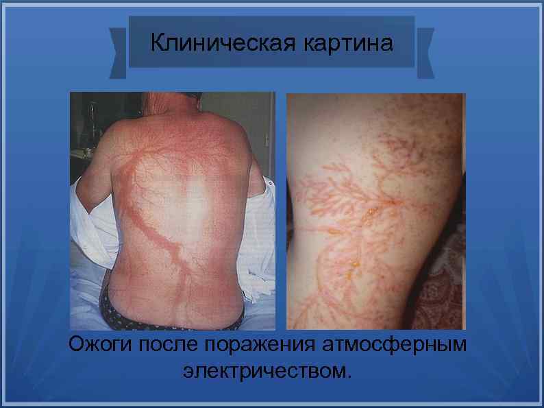 Клиническая картина Ожоги после поражения атмосферным электричеством. 