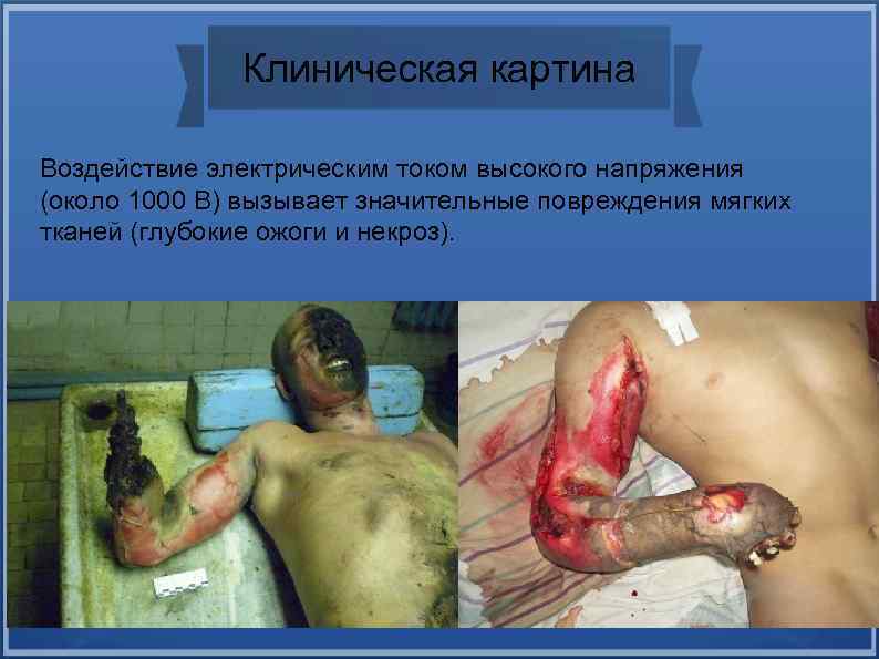 Клиническая картина Воздействие электрическим током высокого напряжения (около 1000 В) вызывает значительные повреждения мягких
