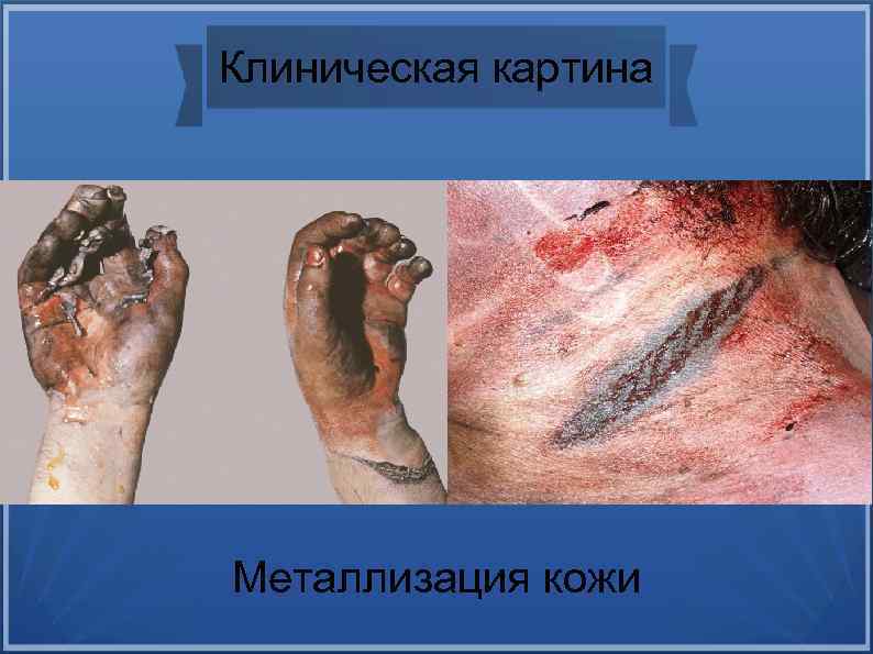 Клиническая картина Металлизация кожи 