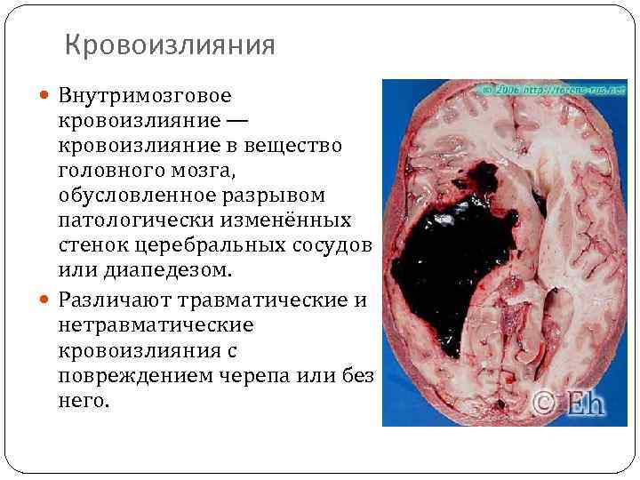 Можно ли выжить после кровоизлияние в мозг