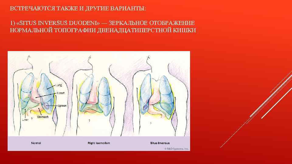 ВСТРЕЧАЮТСЯ ТАКЖЕ И ДРУГИЕ ВАРИАНТЫ: 1) «SITUS INVERSUS DUODENI» — ЗЕРКАЛЬНОЕ ОТОБРАЖЕНИЕ НОРМАЛЬНОЙ ТОПОГРАФИИ