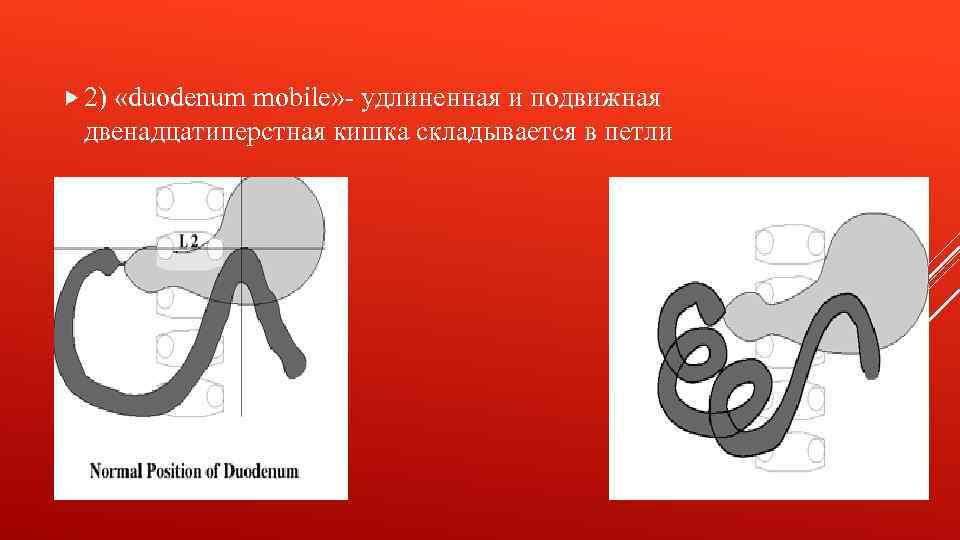  2) «duodenum mobile» - удлиненная и подвижная двенадцатиперстная кишка складывается в петли 