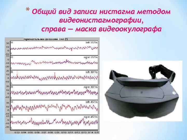 * Общий вид записи нистагма методом видеонистагмографии, справа — маска видеоокулографа 