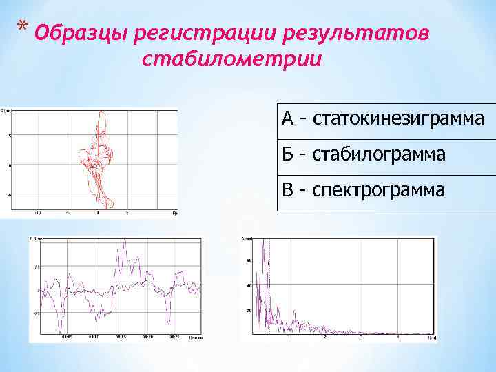 * Образцы регистрации результатов стабилометрии А - статокинезиграмма Б - стабилограмма В - спектрограмма