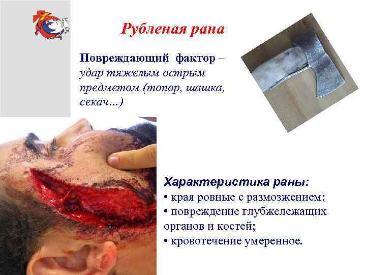 Рубленая рана Повреждающий фактор – удар тяжелым острым предметом (топор, шашка, секач…) Характеристика раны: