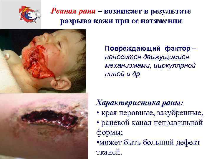 Рваная рана – возникает в результате разрыва кожи при ее натяжении Повреждающий фактор –