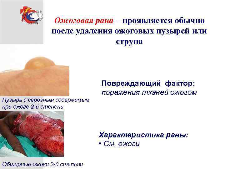 Ожоговая рана – проявляется обычно после удаления ожоговых пузырей или струпа Повреждающий фактор: поражения