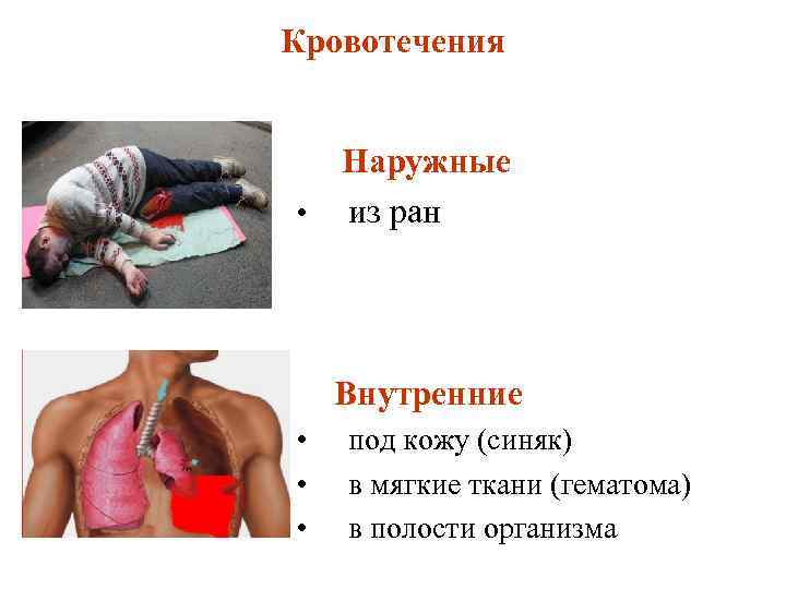 Кровотечения Наружные • из ран Внутренние • под кожу (синяк) • в мягкие ткани