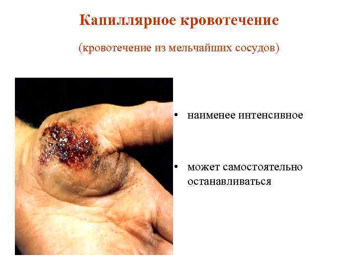 Капиллярное кровотечение (кровотечение из мельчайших сосудов) • наименее интенсивное • может самостоятельно останавливаться 