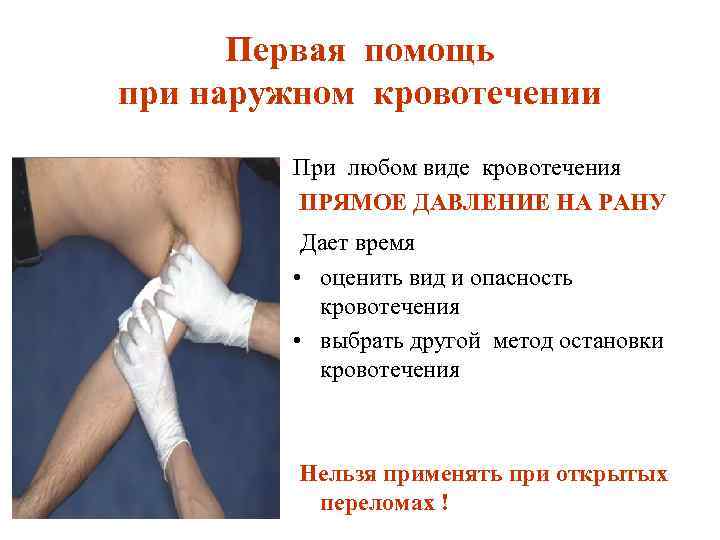 Первая помощь при наружном кровотечении При любом виде кровотечения ПРЯМОЕ ДАВЛЕНИЕ НА РАНУ Дает