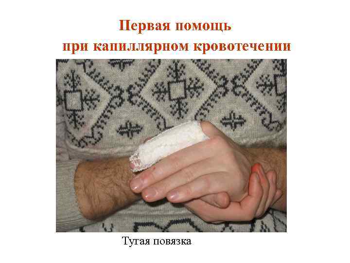 Первая помощь при капиллярном кровотечении Тугая повязка 