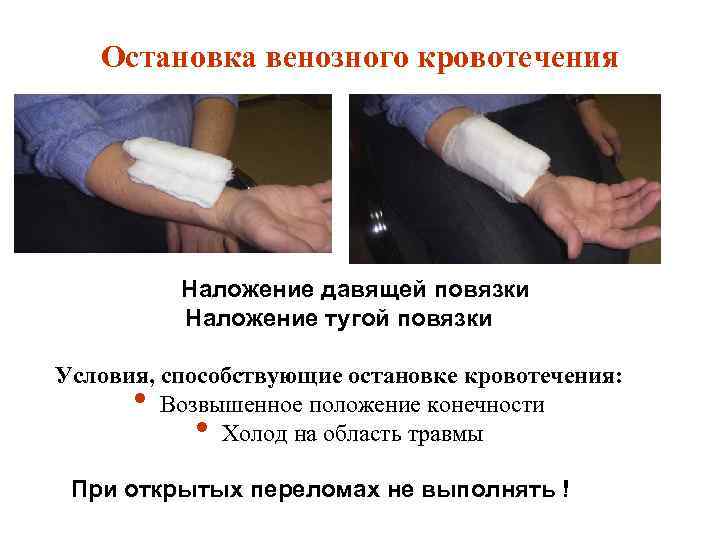 Остановка венозного кровотечения Наложение давящей повязки Наложение тугой повязки Условия, способствующие остановке кровотечения: Возвышенное